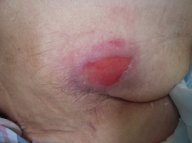 図４ 浅い潰瘍の状態