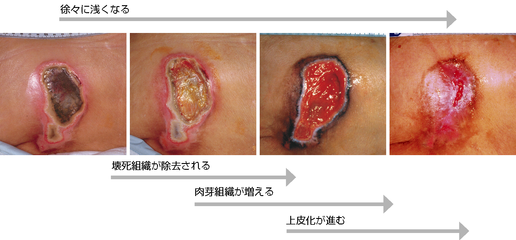 図５ 慢性期の深い褥瘡の代表的な治癒過程