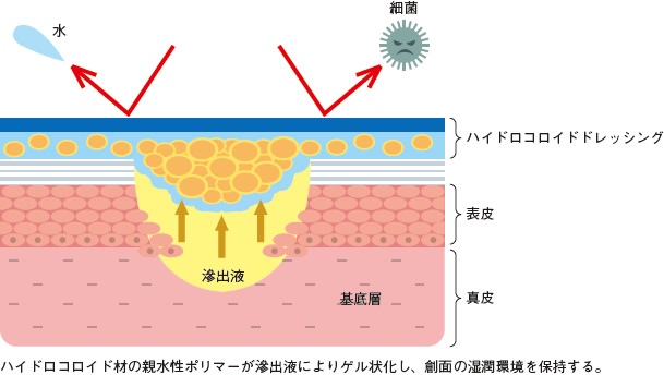 これだけは知っておきたいドレッシング材の使い方 Part6 褥瘡 じょくそう 治療 ケアのカギを握るドレッシング材 外用薬の使い方 アルメディアweb