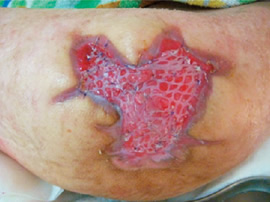 図１ 植皮術の症例：メッシュ植皮術