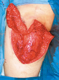 図２ 皮弁形成術の症例：後大腿皮弁の挙上