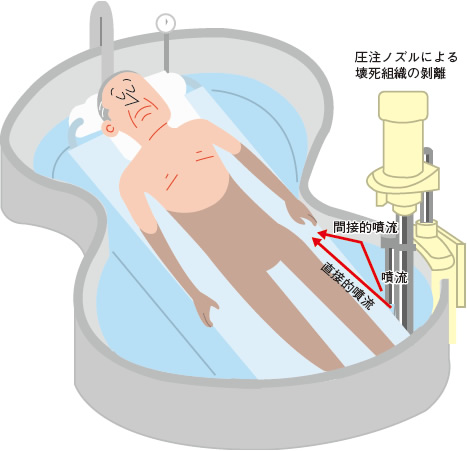 図３ ハバード浴療法