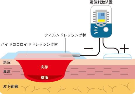 図１ 電気刺激療法