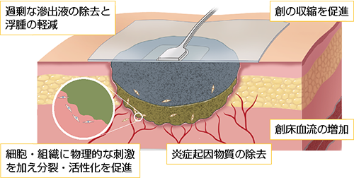 図２ 陰圧閉鎖療法の作用