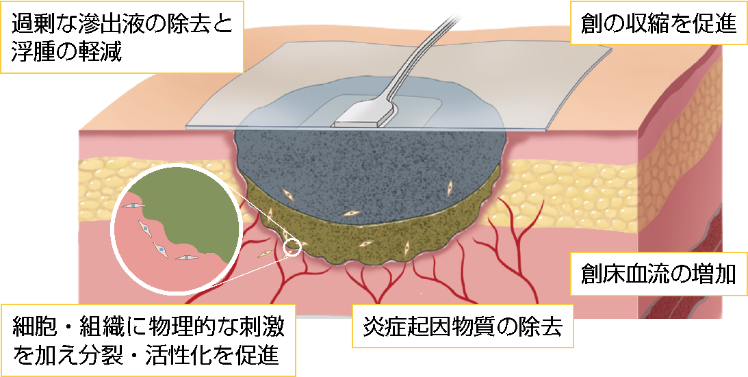 図２ 陰圧閉鎖療法の作用