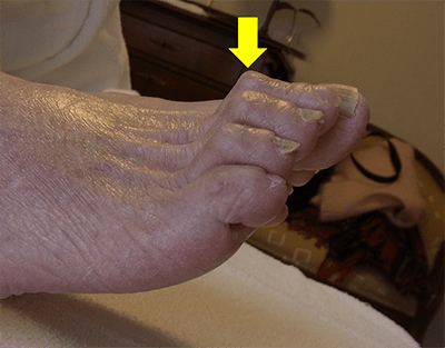 2 足の変形 アルメディアweb