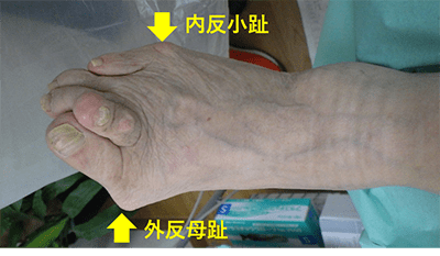 2 足の変形 アルメディアweb