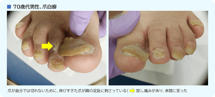 爪切り困難例