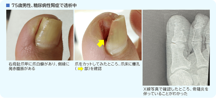 骨髄炎の例