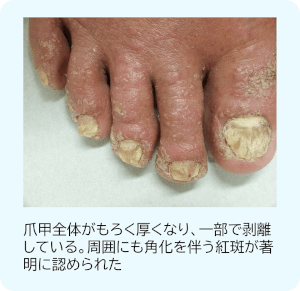 爪の症状が強かった尋常性乾癬患者の1例