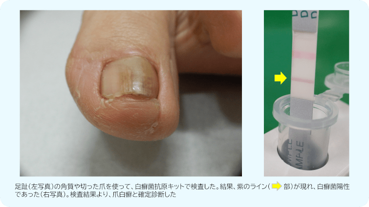 爪白癬の検査の1例