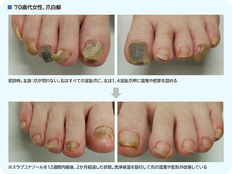 爪白癬の治療経過の例