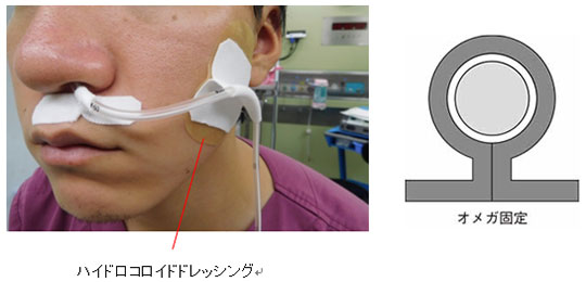 Q8 イレウス管挿入患者のスキントラブルにどう対応する Part3 ハイリスク スキントラブルへの対処 アルメディアweb