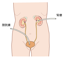 腎瘻・膀胱瘻
