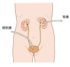 腎瘻・膀胱瘻