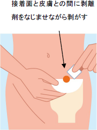 ワイプタイプ_接着面と皮膚との間に剥離剤をなじませながら剥がす