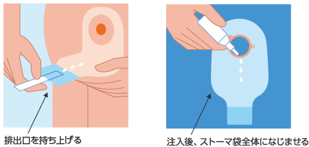 排出口を持ち上げる　注入後、ストーマ袋全体になじませる