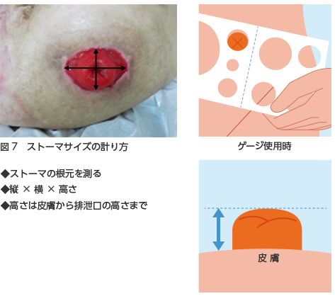 ストーマサイズの計り方　ゲージ使用時