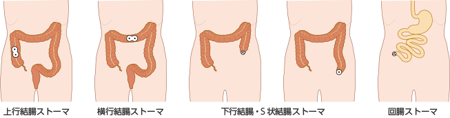 図1　消化管ストーマの種類