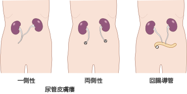 図2　尿路ストーマの種類