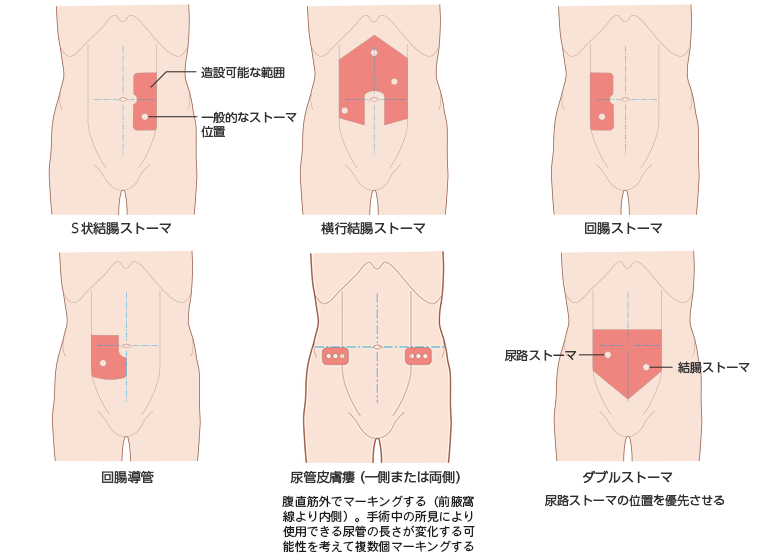 図3　一般的なストーマ造設位置および造設可能な範囲