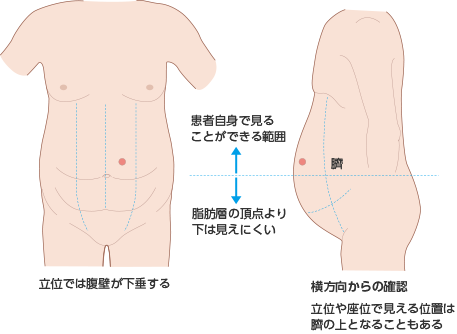 図4　肥満者のマーキング例