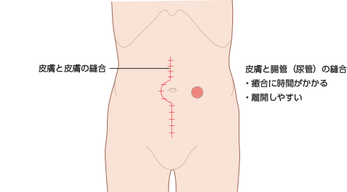 図1　一般的な手術創とストーマ創