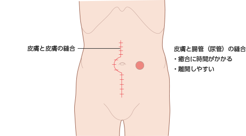 術後早期合併症 ストーマの術前 術後ケア アルメディアweb