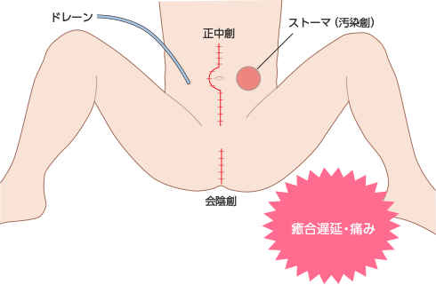 図2　腹会陰式直腸切除術の術後創