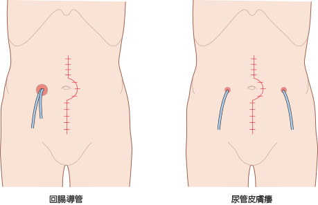 術後早期合併症 ストーマの術前 術後ケア アルメディアweb