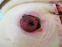図2　ストーマ粘膜皮膚縫合部のストーマ粘膜が壊死し、壊死組織が除去されると粘膜皮膚接合部の離開が発生