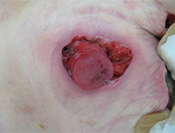 図2　ストーマ粘膜皮膚縫合部のストーマ粘膜が壊死し、壊死組織が除去されると粘膜皮膚接合部の離開が発生