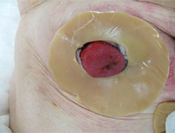 図5　離開創部の感染や排膿が落ち着いた段階で、創傷被覆材（アルギン酸カルシウム、銀イオン含有アルギン酸カルシウムなど）を創部に充填し、板状皮膚保護剤で被覆してからストーマ装具を貼付する