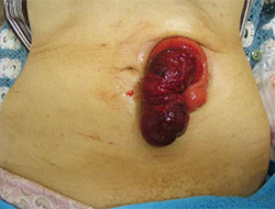 図2 脱出した腸管が嵌頓し、血流障害を起こしている状態