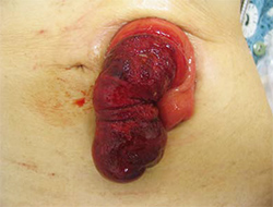 図2 脱出した腸管が嵌頓し、血流障害を起こしている状態
