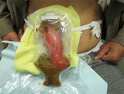 図5　脱出した腸管が長く、袋内が腸管で埋められてしまうことを避けるために回腸ストーマ用のストーマ装具を使用している状態