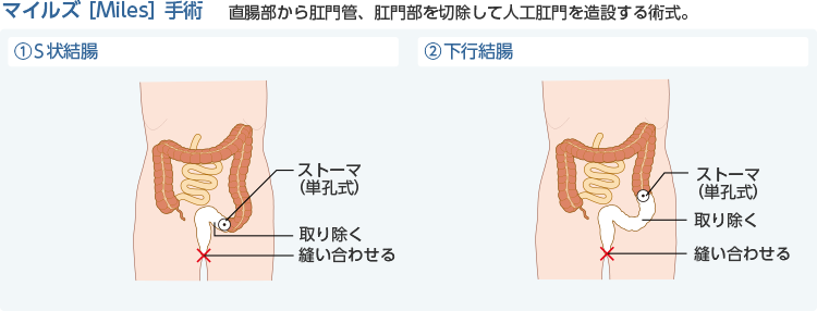 ストーマ造設を行う疾患と術式 ストーマについての基礎知識 アルメディアweb