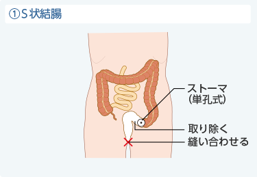 ①S状結腸
