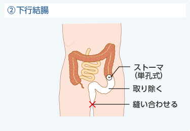 ②下行行結腸