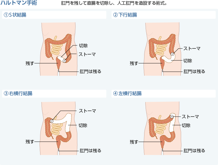 ストーマ造設を行う疾患と術式 ストーマについての基礎知識 アルメディアweb