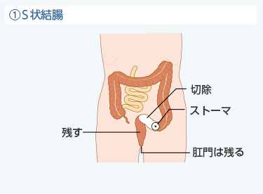 ①S状結腸