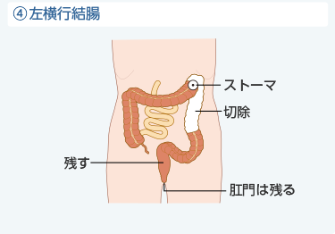 ④左横行結腸