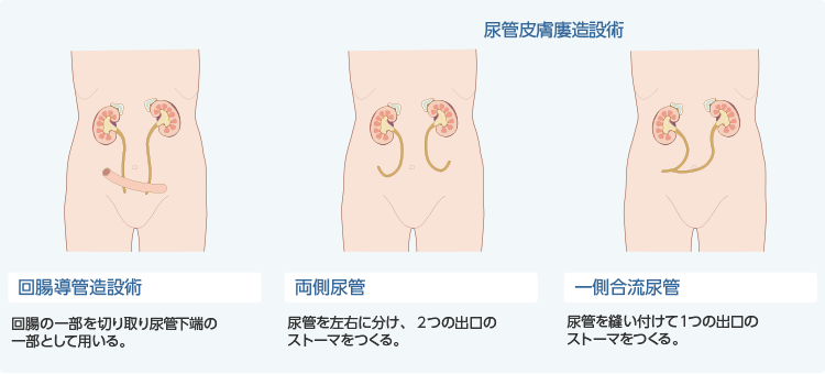 図2　尿路ストーマ造設術の代表的なもの