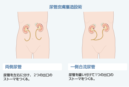 図2　尿路ストーマ造設術の代表的なもの