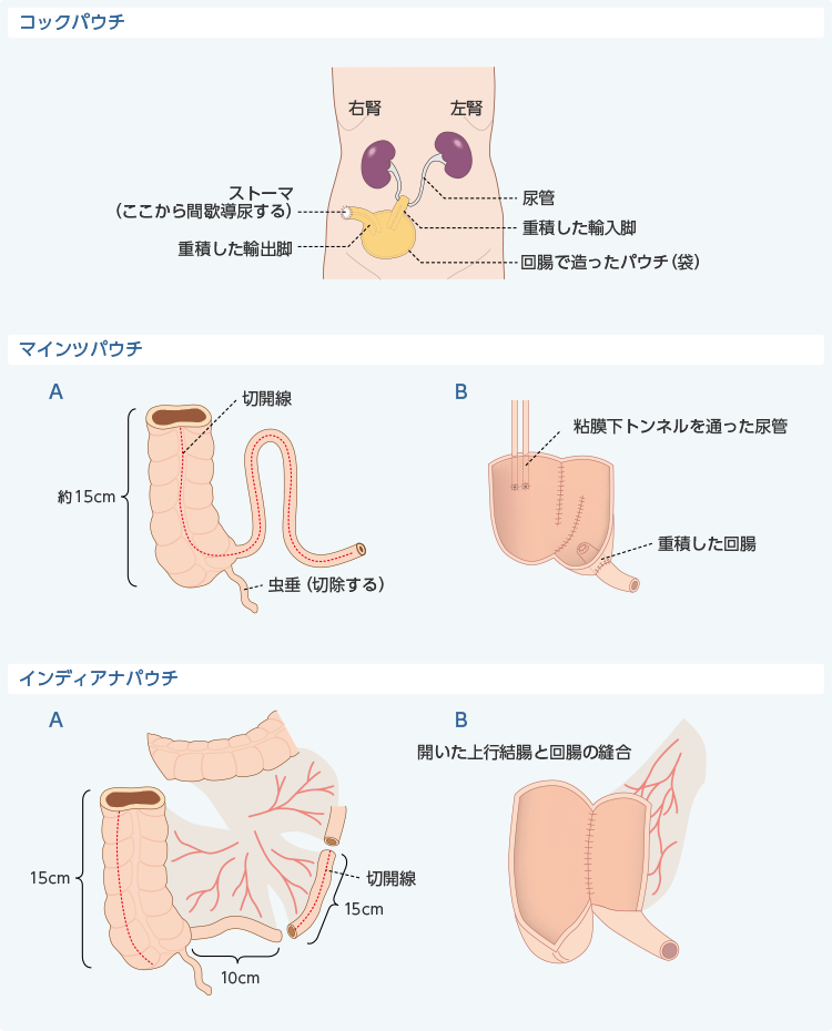 図3　禁性人工膀胱造設術