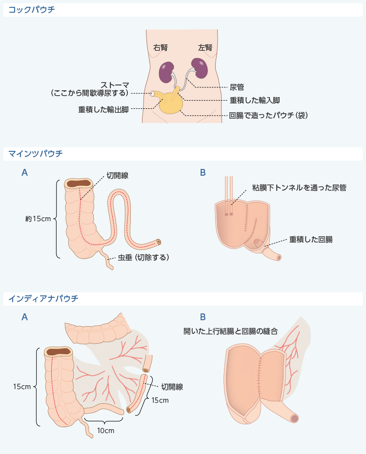 【裁断済み】ストーマ手術手技