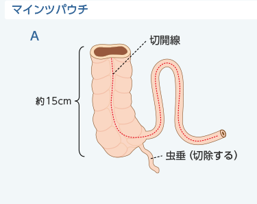 マインツパウチA