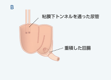 マインツパウチB