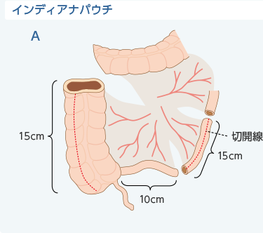 インディアナパウチA