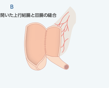 インディアナパウチB